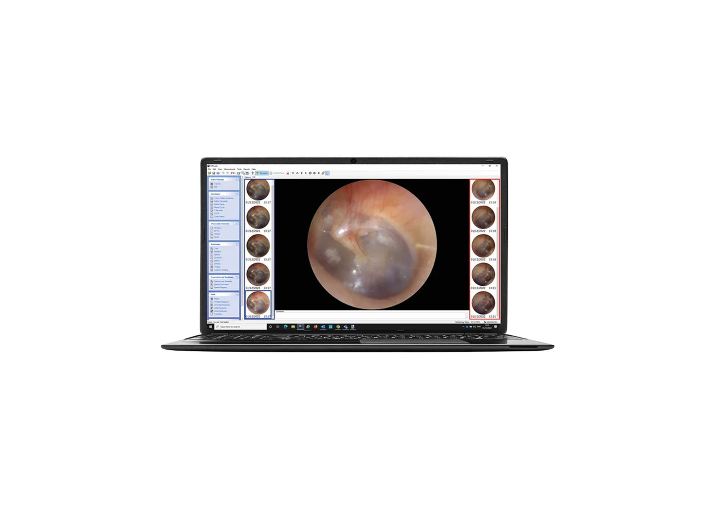 Aurical Otocam 300 - Natus